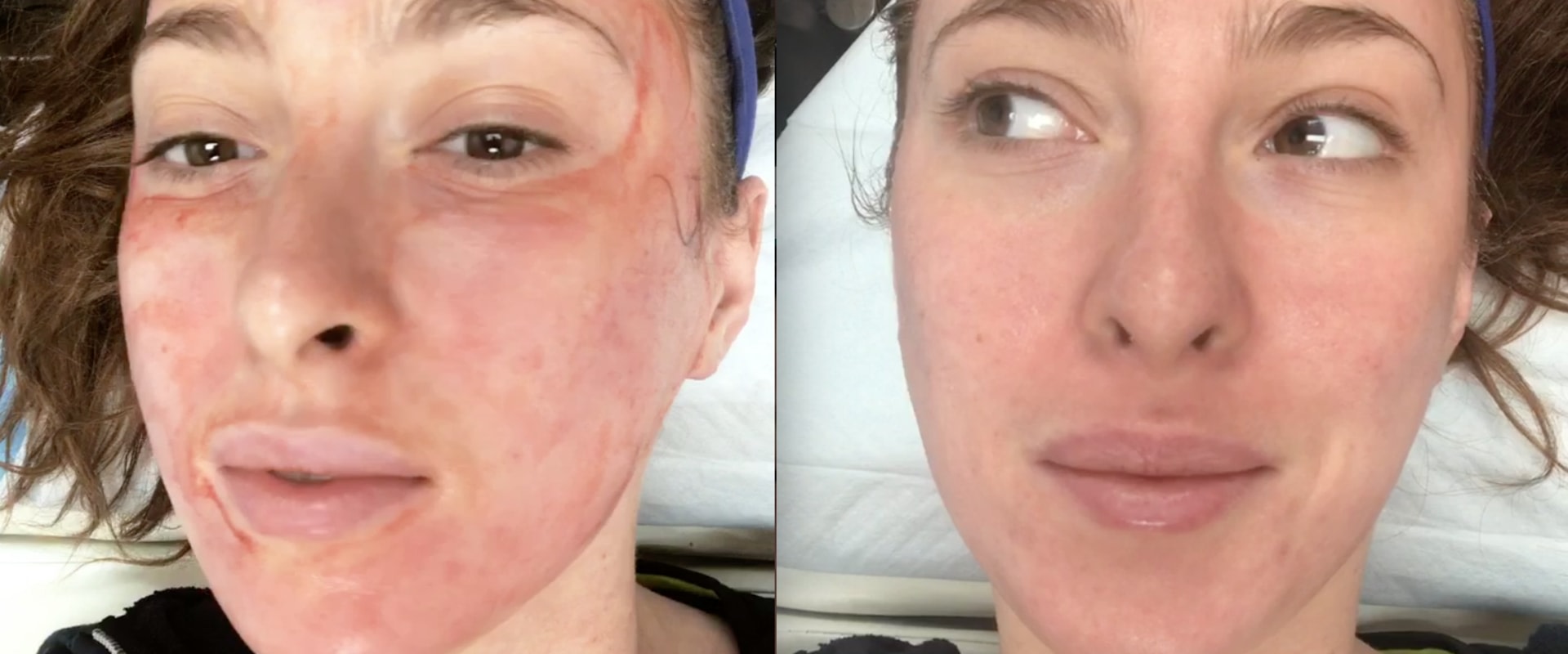The Benefits of PRP Facial Treatments for Acne Scars