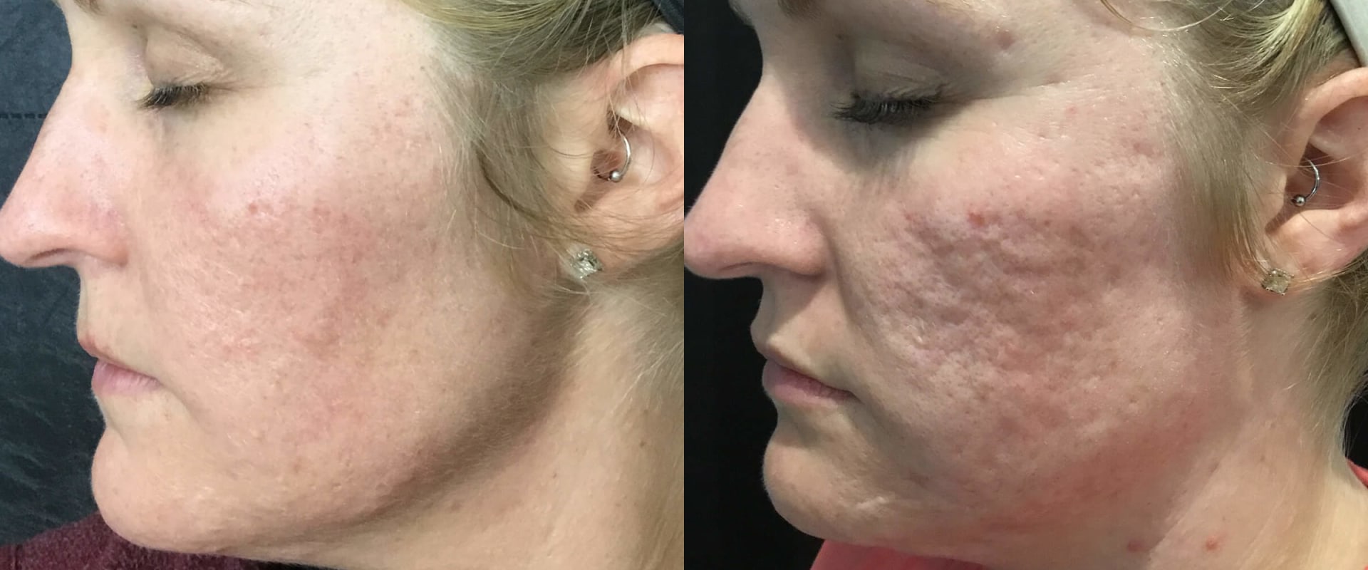Can PRP Microneedling Help Reduce Acne Scars?