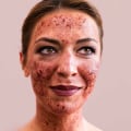 Does vampire facial help pigmentation?