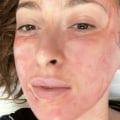 The Benefits of PRP Facial Treatments for Acne Scars