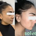 Is vampire facial good for acne scars?
