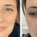 Is a Vampire Facial Safe During Pregnancy?