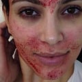 Kim Kardashian West's Vampire Facial: Who Did It and What Happened?