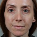 Is the Vampire Facial FDA Approved?