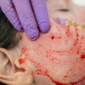 What Does a Vampire Facial Do?