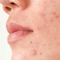 The Best Facial Treatments for Acne Scars