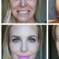 Does Vampire Facial Make You Look Younger?