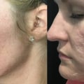 Can PRP Microneedling Help Reduce Acne Scars?