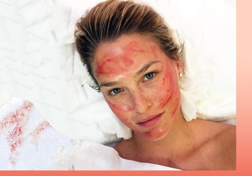 How Long Does a Vampire Facial Take?