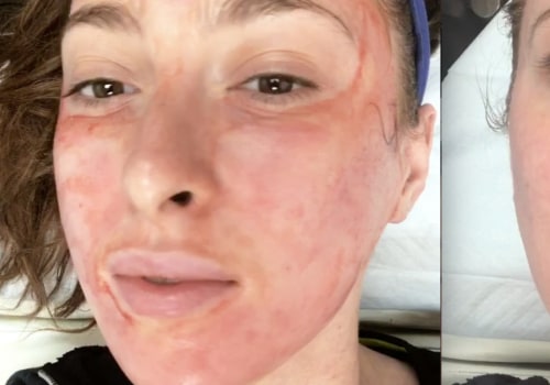 Is prp facial good for acne scars?