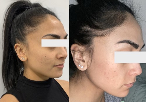 Is Vampire Facial the Best Treatment for Acne Scars?