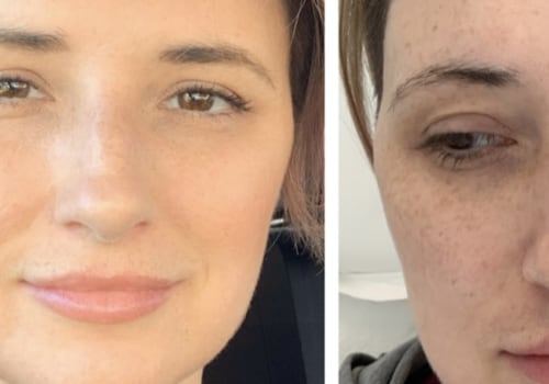 Is a Vampire Facial Safe During Pregnancy?