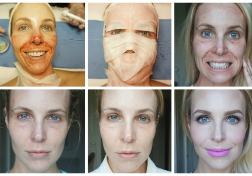 What is a Vampire Facial and How Can It Help Your Skin?
