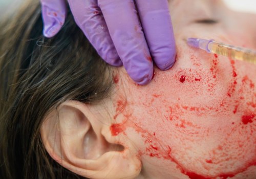 The Vampire Facial Procedure: A Comprehensive Guide