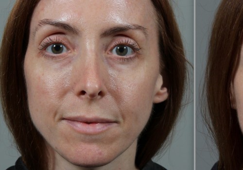 Is the Vampire Facial FDA Approved?