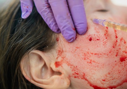 What Does a Vampire Facial Do?