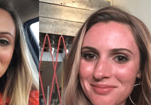 The Benefits of a Vampire Facial: Is it the Same as Microneedling?
