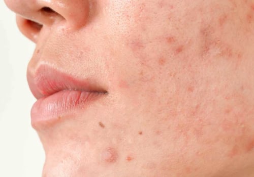 What facial is good for acne scars?
