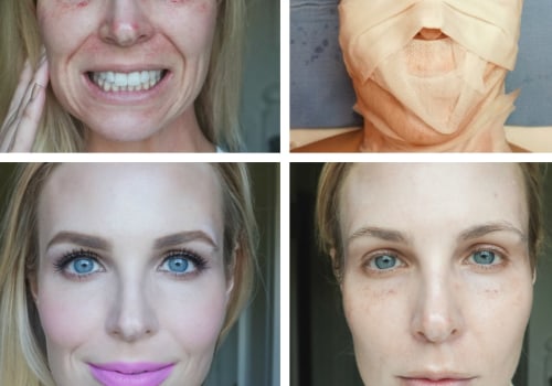 Does vampire facial make you look younger?