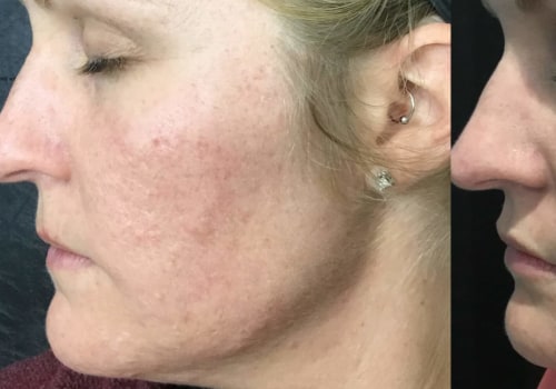 Can PRP Microneedling Help Reduce Acne Scars?